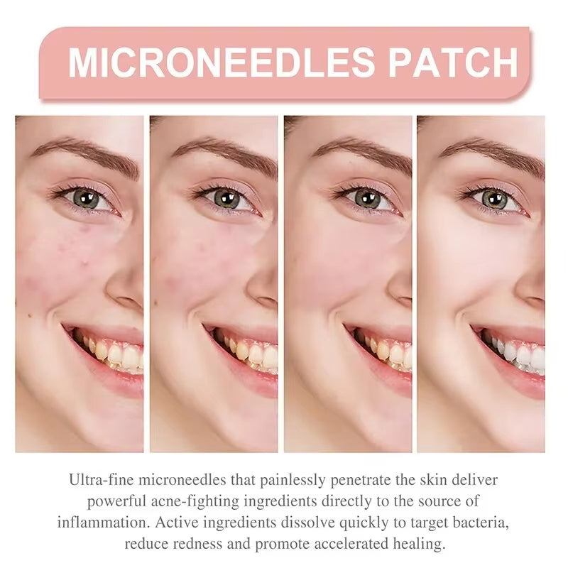 Acne Spot Healing Patches – Invisible Waterproof Stickers for Pimple Removal, Marks, and Scar Care - CartRare
