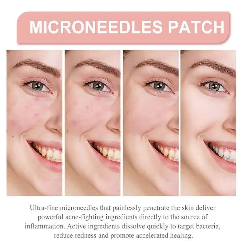 Acne Spot Healing Patches – Invisible Waterproof Stickers for Pimple Removal, Marks, and Scar Care - CartRare