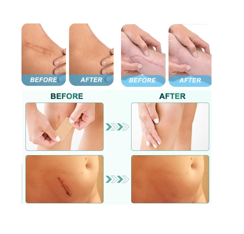 Silicone Scar Tape Reusable - CartRare